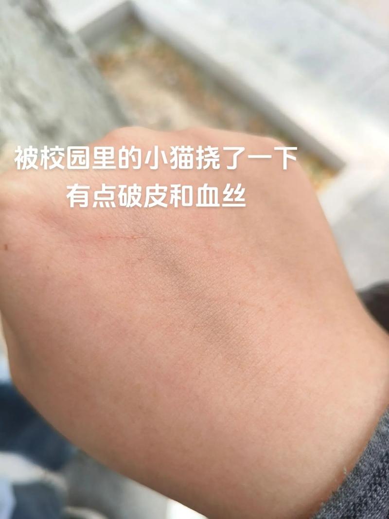 猫抓伤别慌，水洗消毒打疫苗！（被猫挠了怎么办）