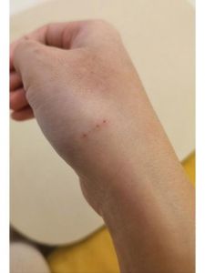 狗抓伤皮？速洗打针！（被家里宠物狗抓了破皮）