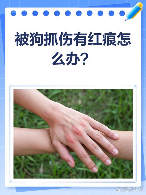 新狗抓妹妹怎么办？注意处理防感染（被自家养的宠物狗抓伤了）