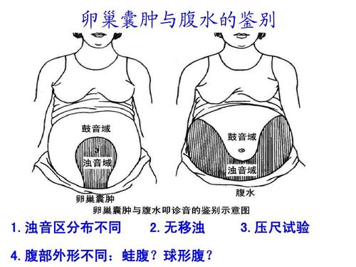 蛙状腹是什么病？需警惕！（蛙腹图片）