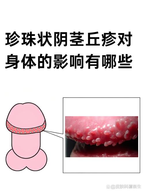 小疙瘩不痛，清洁干燥可自愈（龟的头上珍珠疹图片）