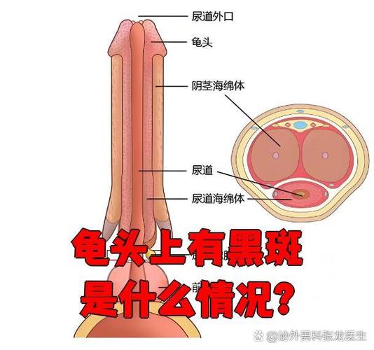 龟头黑斑？原因多，速就医！（龟 头上长了黑斑是怎么回事）
