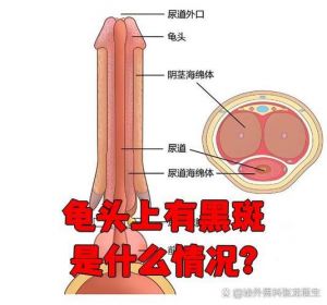 龟头黑斑？原因多，速就医！（龟 头上长了黑斑是怎么回事）