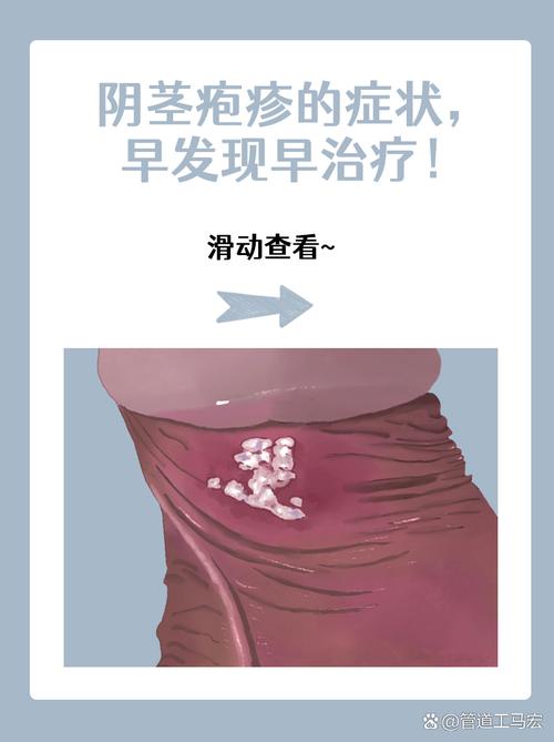 龟头水泡？快查查原因！（龟 头上长了小水泡图片）