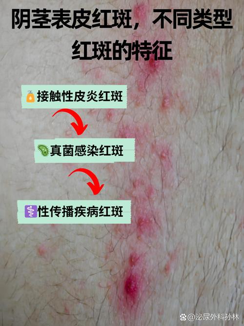 龟头红斑是什么原因引起的？（龟的头上长了红斑图片）