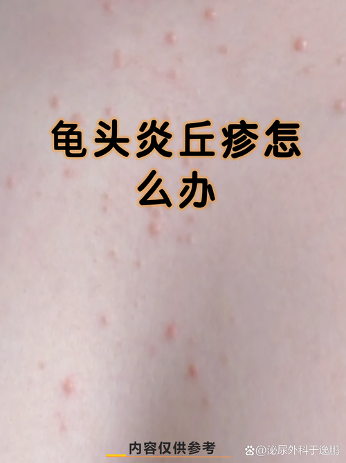龟头湿疹症状多样，需综合治疗（龟 头上湿疹图片）