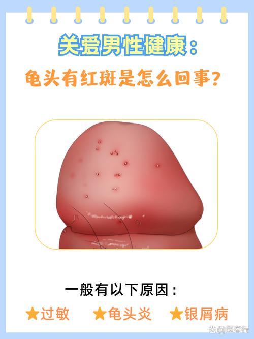 龟头红点？炎症惹的祸，及时就医早治疗！（龟的头上有小红点图片）