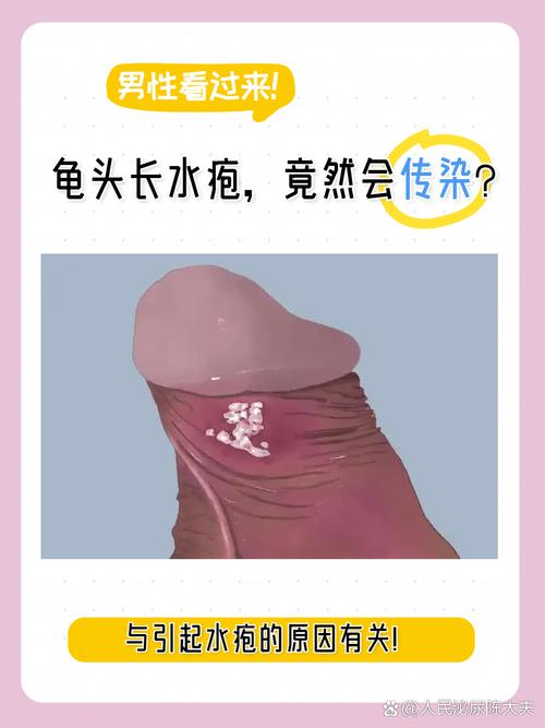 龟头水泡？快查查原因！（龟 头上长了小水泡图片）