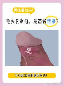龟头水泡？快查查原因！（龟 头上长了小水泡图片）