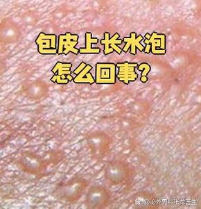 龟头水泡？快查查原因！（龟 头上长了小水泡图片）